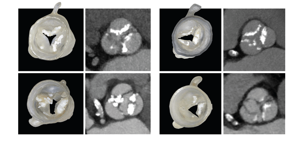 pre-procedural-fit-testing-transcatheter-aortic-valve-replacement-tavr-valves-using-parametric-modeling-3d-printing-6 pre-procedural-fit-testing-transcatheter-aortic-valve-replacement-tavr-valves-using-parametric-modeling-3d-printing-6
